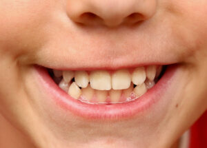 yellow teeth in kids