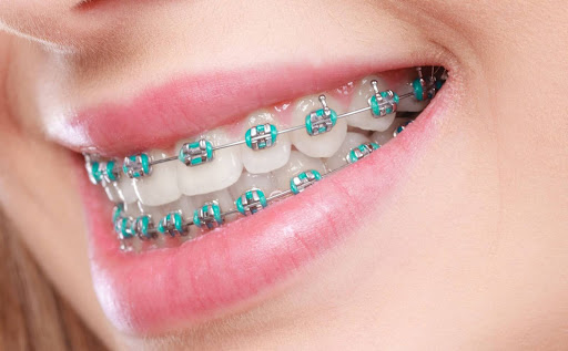 braces cost depends on treatment needs