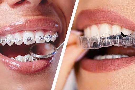 Which is cheaper braces or Invisalign