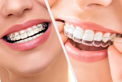 metal braces and Invisalign cost comparison