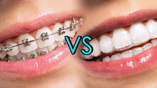 braces vs Invisalign price differences