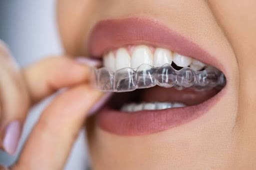 How Invisalign works step by step, clear aligner process